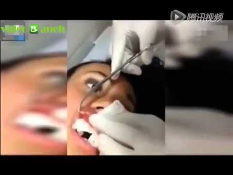 Video dokter keluarkan belatung di bibir wanita ini bikin merinding