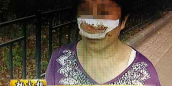 Telponnya Tak diangkat, Seorang Suami Tega Menggigit Hidung Istrinya!